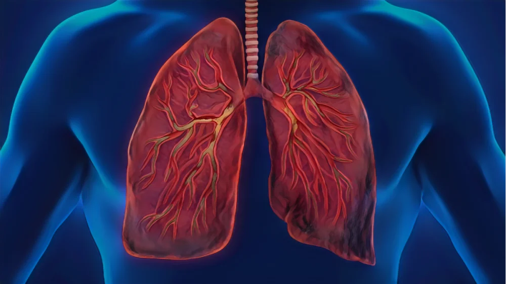 Bronchitis