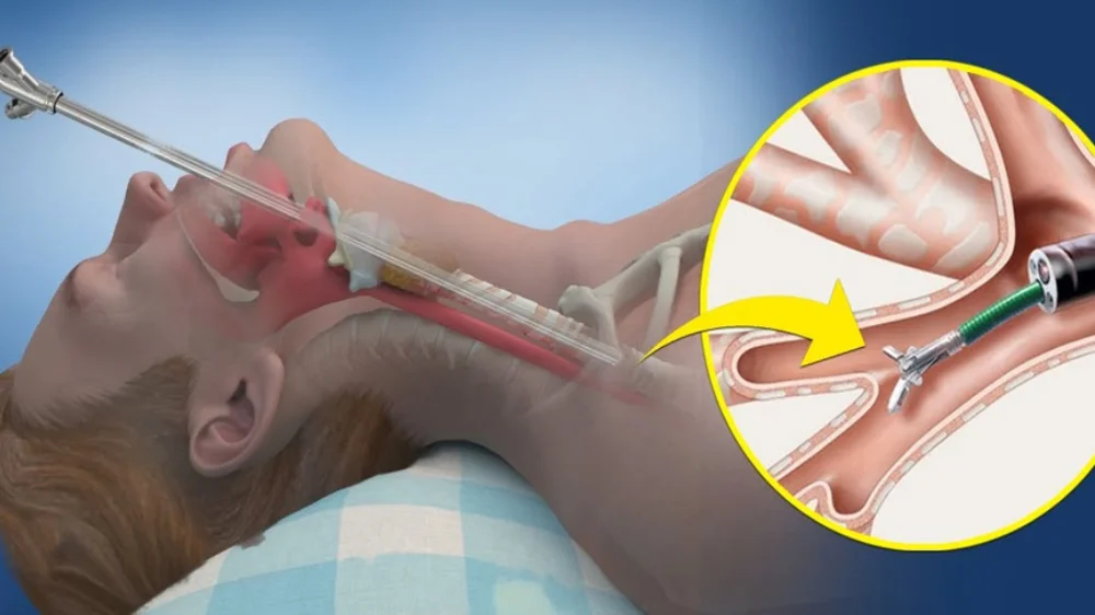 Bronchoscopy