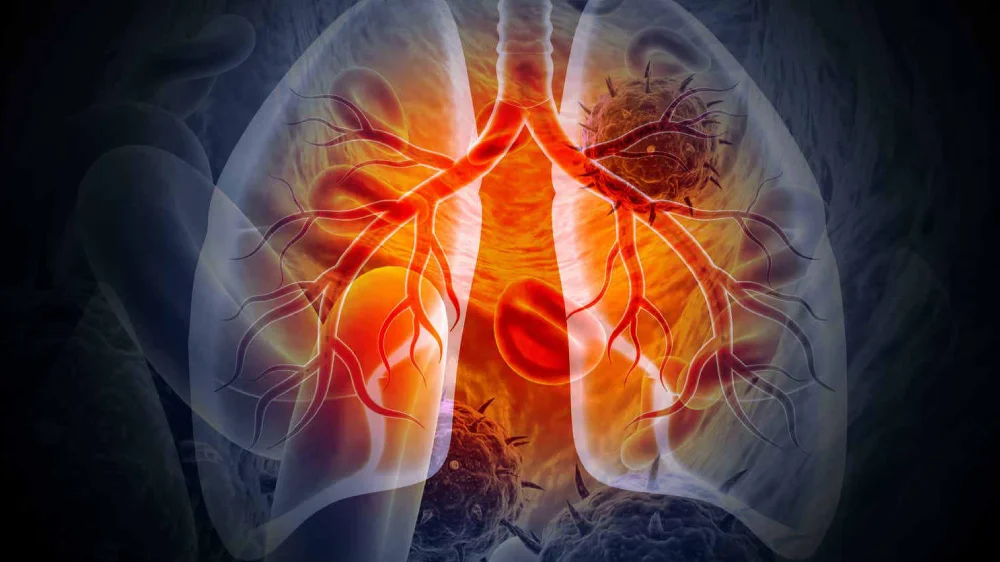 Lung Cancer (1)