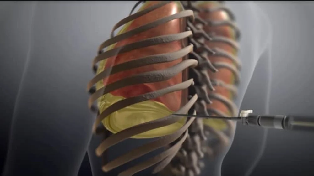 Pleural Tapping