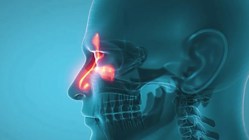 Rhinitis