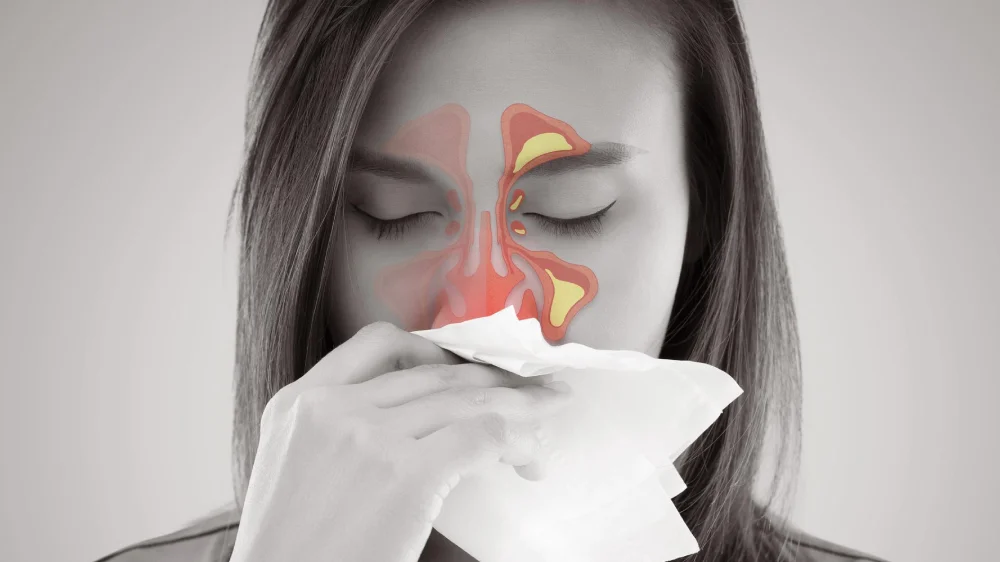 Sinusitis