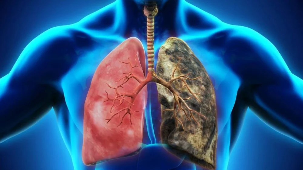 Smoking-Related Lung Diseases