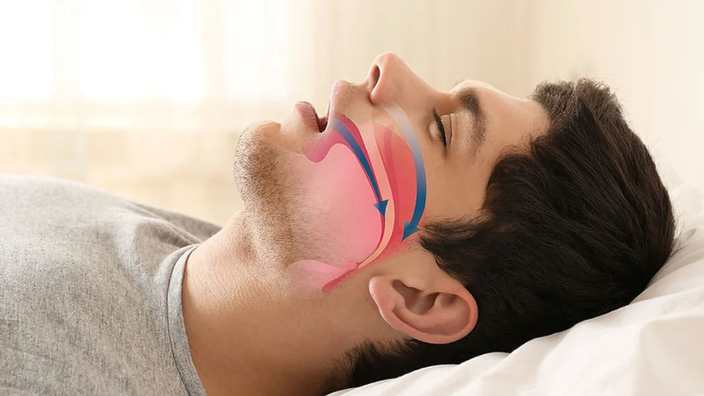 Snoring