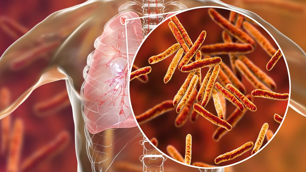 Tuberculosis
